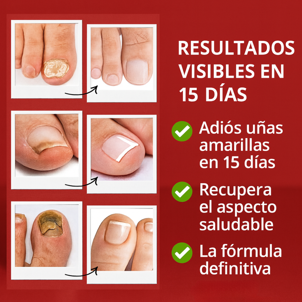 Lindonia® FungiNail Triple Acción